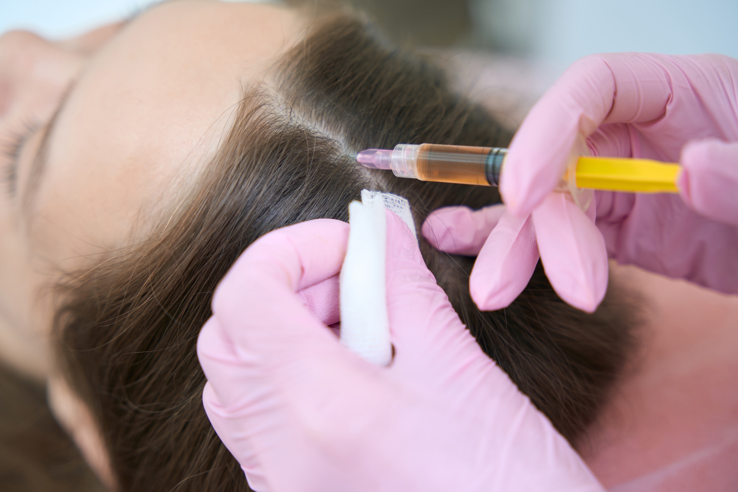 Mesoterapia Capilar